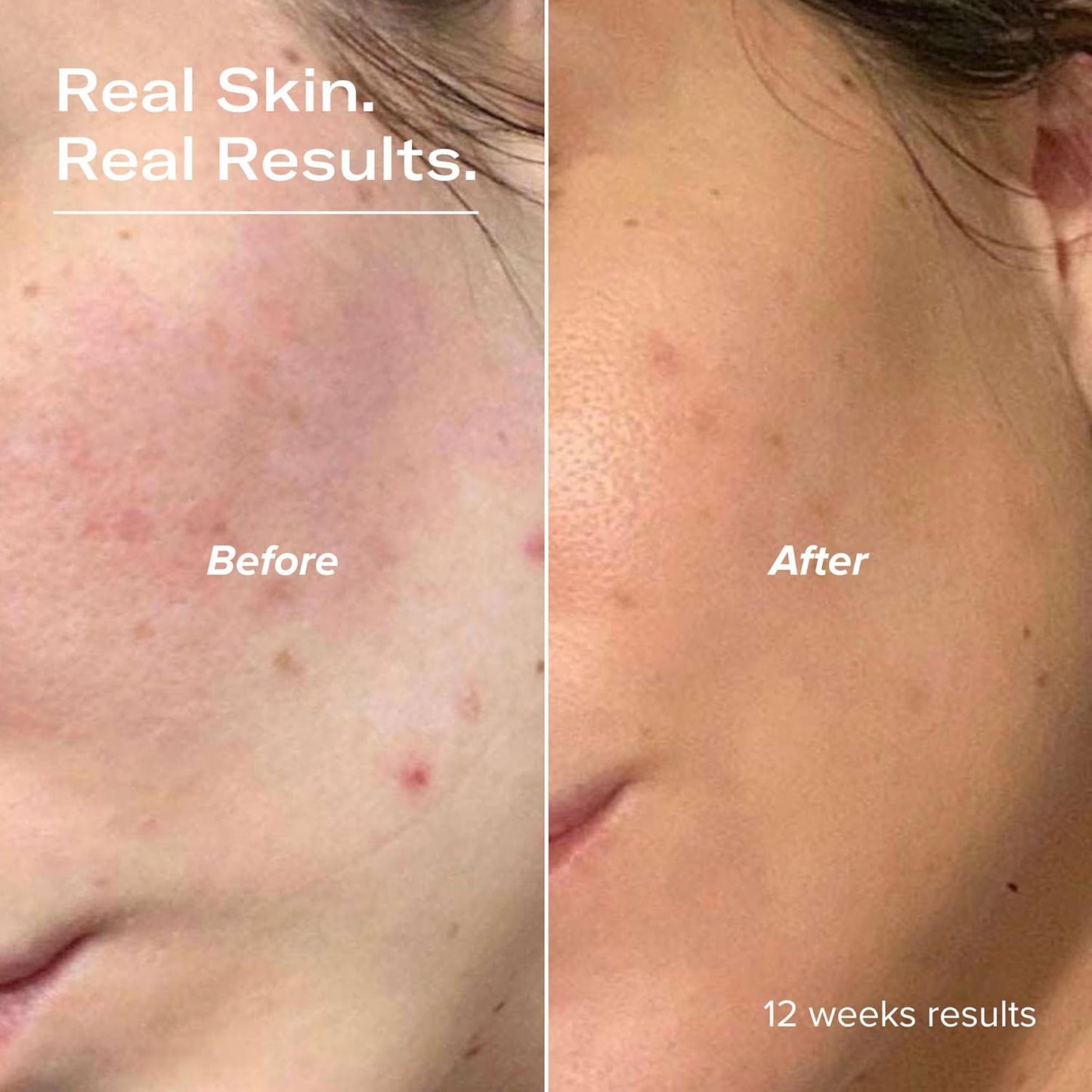 PLUMP Hyaluronic Acid Serum with 5D Hyaluronic Complex, Ectoin, Plant Ceramides, Vitamins B5 & E, Deep Hydration, Strengthens Skin Barrier, Fragrance-Free, 1 fl oz