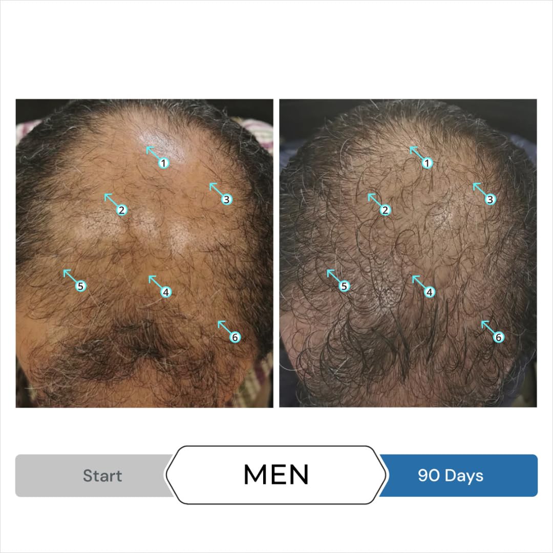 Hair Regrowth Stimulation Kit for Men| Spectral.UHP + Revita Shampoo