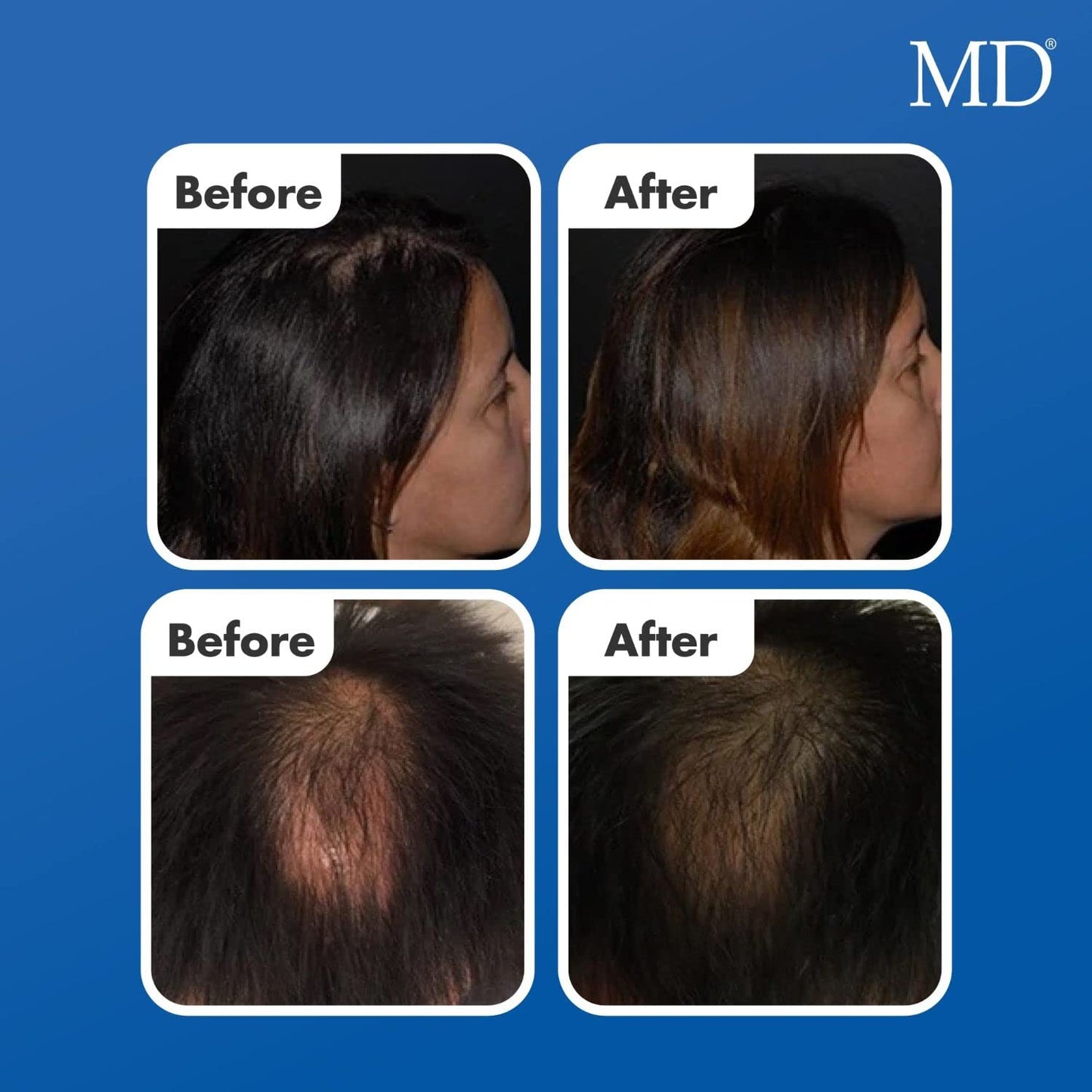 MD Factor Natural Hair Growth Serum | Follicle Energizer Serum - Prevents Thinning Hair & Hair Loss By Stimulating Hair Follicles To Produce Thicker, Fuller Hair (30-Day Supply Per Tube)