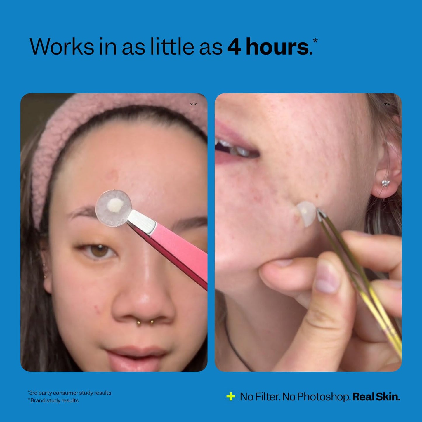 Peach Slices | Acne Spot Dots | Hydrocolloid Acne Patches | For Zits, Blemishes, & Breakouts | Vegan | Cruelty-Free | Pimple Patches | Facial Skin Care Products | 3 Sizes (7mm, 10mm, & 12mm) | 30 Ct