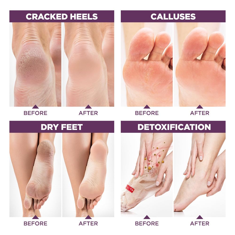 Lavinso Lavender Foot Exfoliator Peeling Mask for Dry Cracked Feet - 3 Pack - Remove Dead Skin and Callus - Foot Peel Mask for Baby Soft Feet