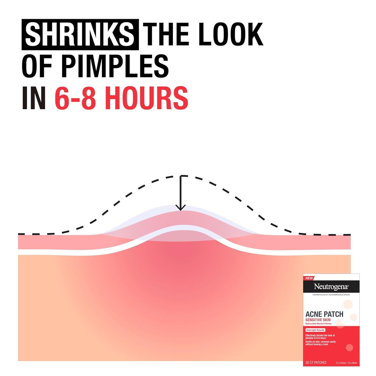 Neutrogena Sensitive Skin Blemish Patches, Acne Patches for Sensitive Skin, Hydrocolloid Treatment Visibly Shrinks Pimples Overnight, 2 Sizes, 30 Count