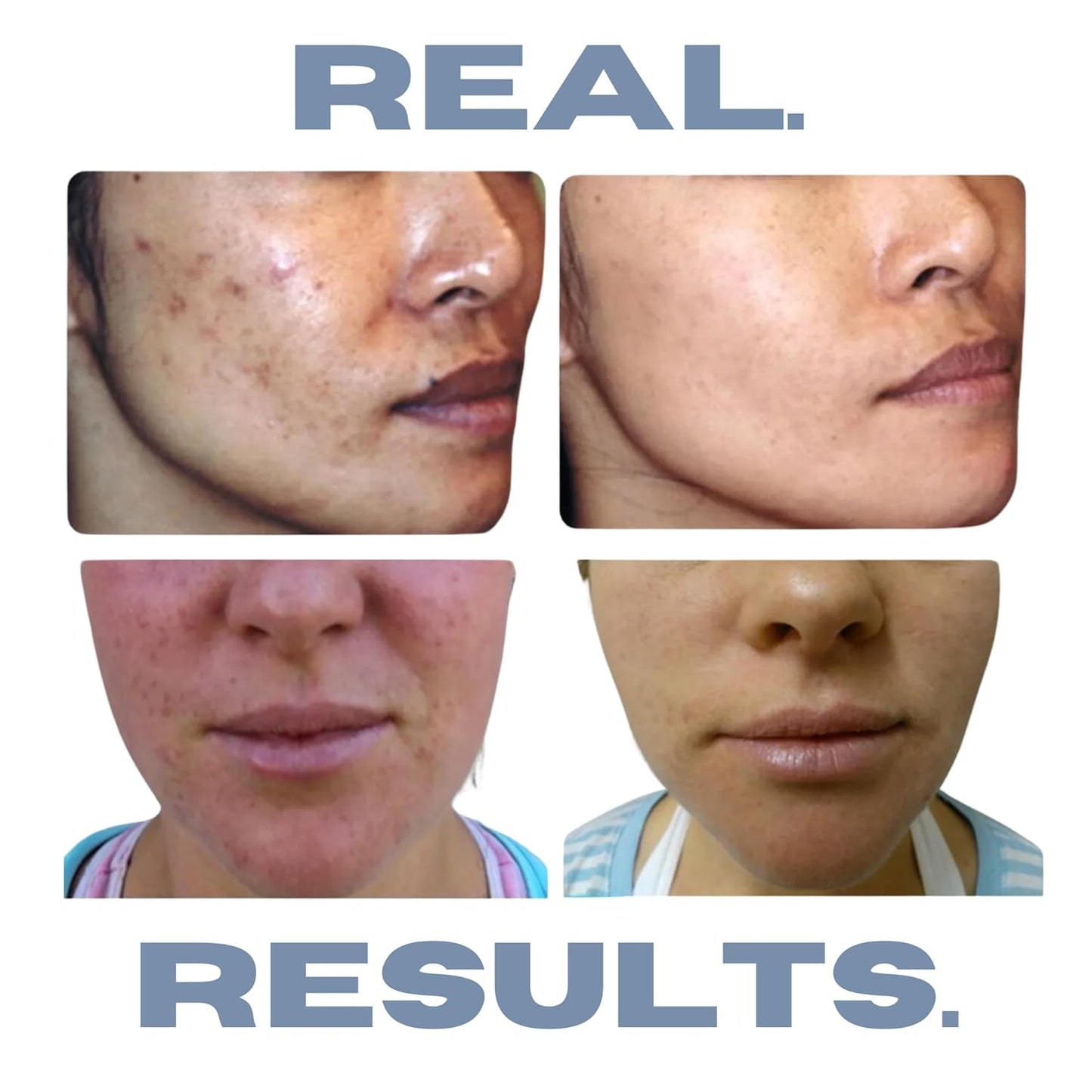 Clarifying Toner for Acne and Blemishes, Face Toner, Facial Toner, Skin Toner, Acne Toner, Toner Oily Skin, Salicylic Acid Toner, Astringent for Face, Toners, 4 Fl Oz