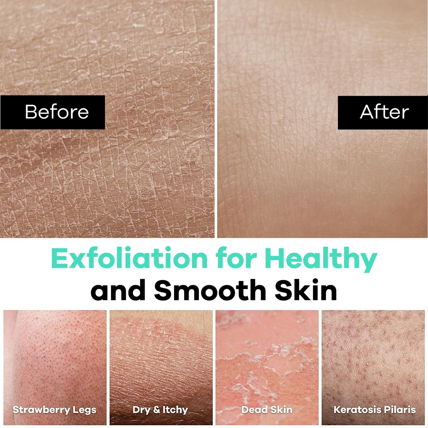 Dermasuri Deep Exfoliating Glove – Korean Exfoliating Body Scrubber for Shower, Buffs Dry & Dead Skin, Keratosis Pilaris Treatment, Body Scrub, Skin Exfoliator for Men & Women, Reusable Teal Mitt